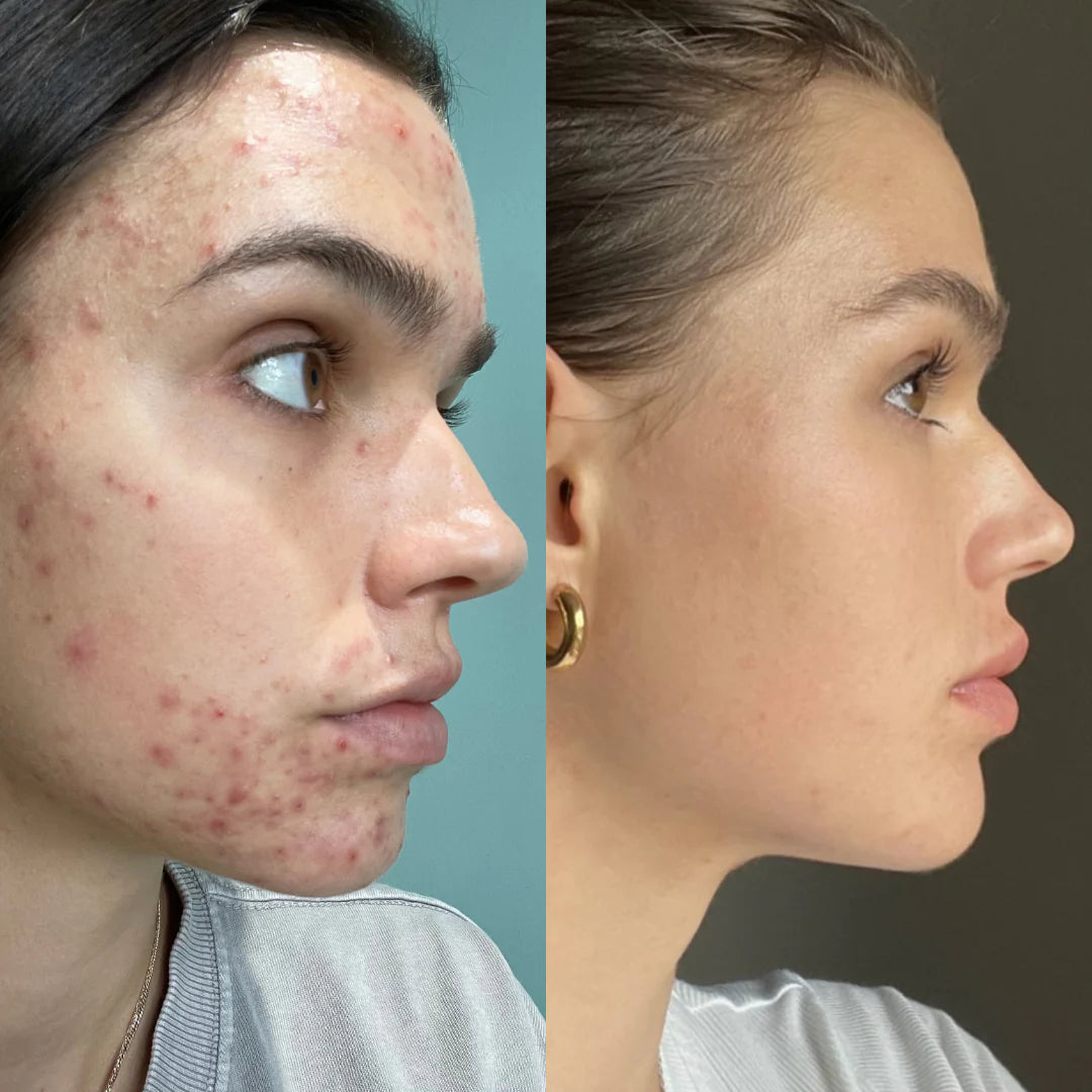 Alopure® - Pommeau de douche filtrant + 3 filtres offerts